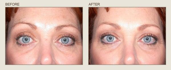 Before & After

Center for Eye & Laser Surgery- Severna Park, Maryland