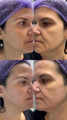 Glo2facial with carbon peel. before and right after service