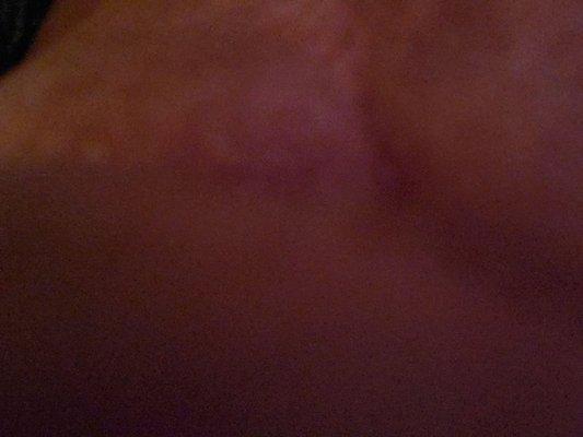 It a pic of back of arish on back left knee..there r 2 on my inner thighs that r just red blotches and under my eyes..