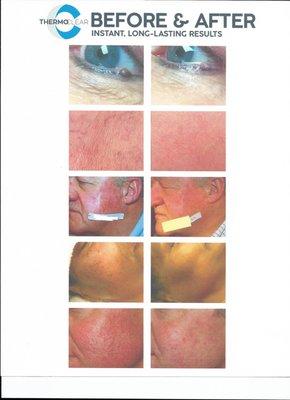 ThermoClear treats epidermal imperfections in seconds!