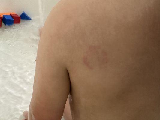 Bite mark on my two year old from child care