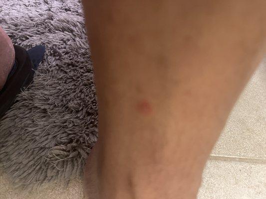 Lower leg leg of bed bug bites