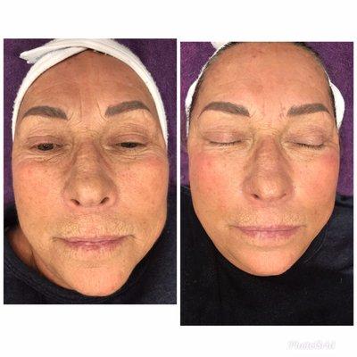 Botinol face lift 1st treatment by Tina