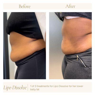 Before after picture of lipo dissolve