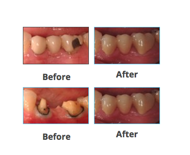 Before: 3 Unit bridge with chipped porcelain molar (supporting metal showing on molar tooth), poor enamel color match to patient's natural