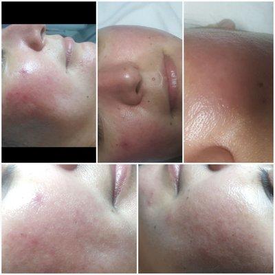 This client is getting a facial to help her Rosacea skin, after her 1st. treatment her skin tone looks brighter & more radiant.