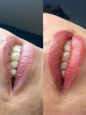 Lip Pigmentation