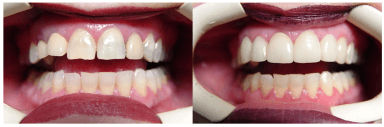 Porcelain Crowns and Bridges