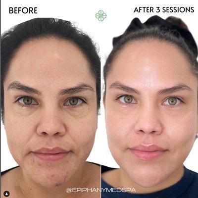 Patient received 3 sessions of 4D Facelift + 1 Acne Removal session to achieve these results.