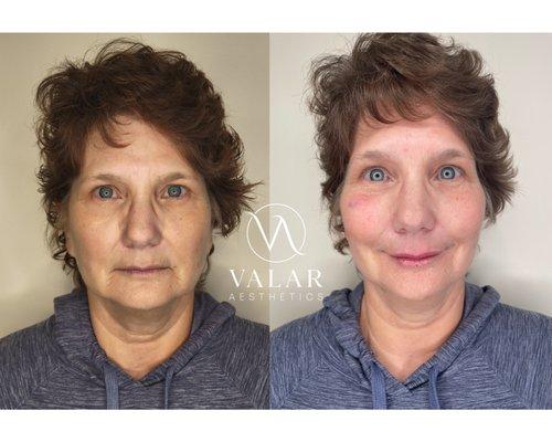 Before and afters of mid-face and lip Restylane filler