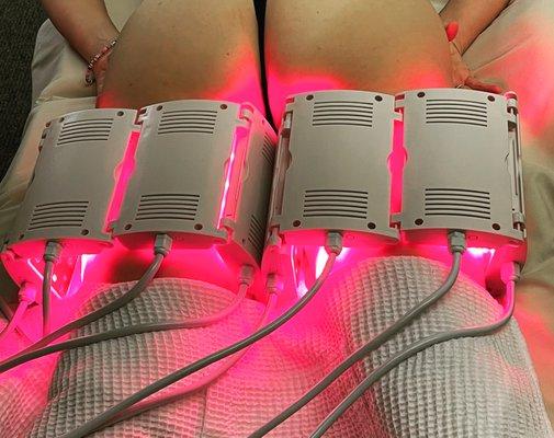 Laser Lipo