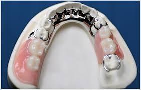 Missing teeth? We can restore function and esthetics with an RPD (removable partial denture)...