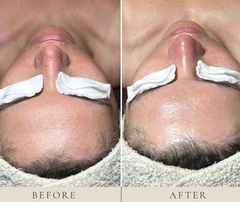 Hydrating facial