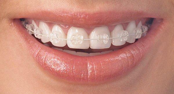 Clear Sapphire Braces