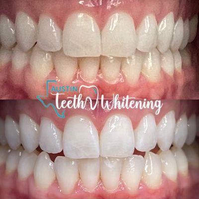 Austin Teeth Whitening