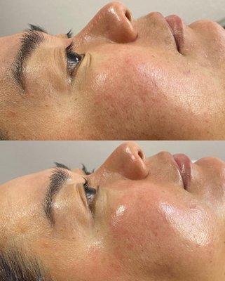 Dermaplaning Glow Facial