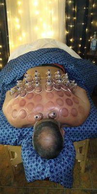 Cupping therapy