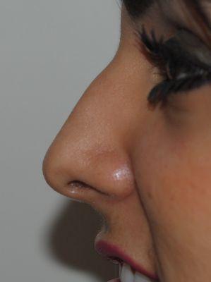 Rhinoplasty Before