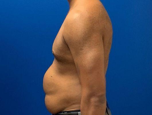 Male liposuction before