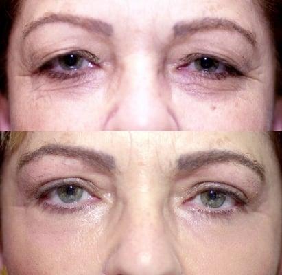 Upper Eyelid Surgery and Laser around the Eyes by Sadove