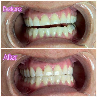 Teeth Whitening:
Gentle lightening Clarifies 2-4 shades in one session