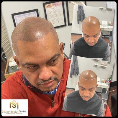 Scalp micropigmentation