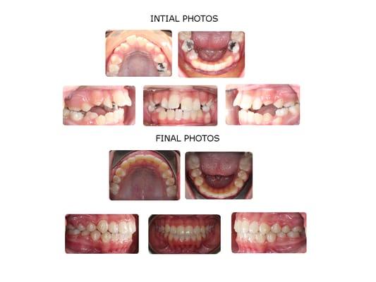 Case treated by Dr. Bella Shen Garnett 12 year old girl treated with braces and no extractions