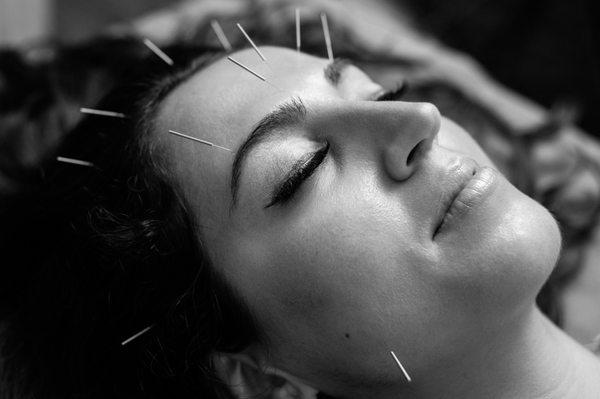 Beauty Acupuncture