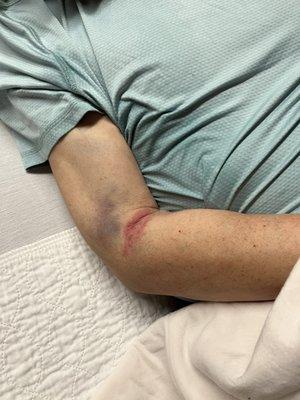 Bruise of the arm from being restrained