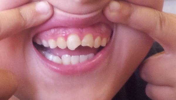 Before photos of my 9 y.o. broken teeth