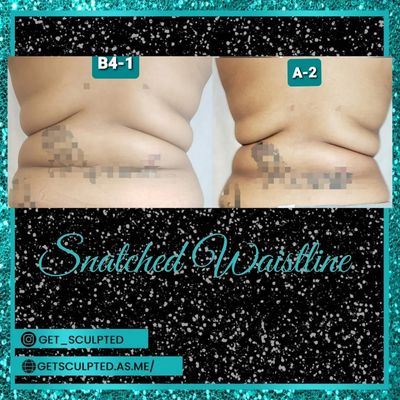 Non-invasive body Sculpting results