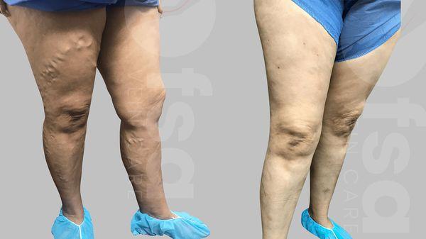 Varicose veins can almost always be identified by their blue or purple color.
Appearance: twisting, bulging, or ropey appearance.