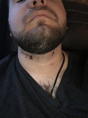 After the shave, I realized that I had gotten a lot of cuts on my neck and here is the dried blood.