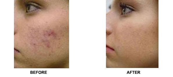 Microneedling for scars, Retexturizing and Collagen Stimuation