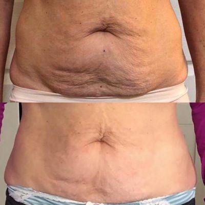 Skin tightening on a woman in her mid 60's.