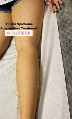 Acupuncture treatment for IT band syndrome