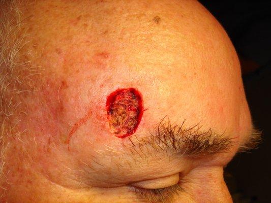 Forehead: Mohs defect of a large skin cancer