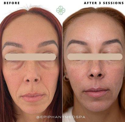 Fotona Laser System: Patient got 3 sessions of 4D Facelift + 1 session of SmoothEye Lase.