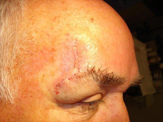 Forehead: Repair of a large defect