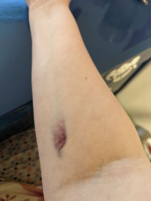 Bruising on my arm 24 hrs after blood draw.