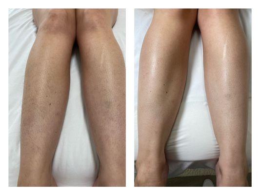 Before and after sugaring