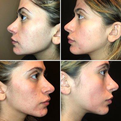 Check out this amazing skin transformation from microneedling treatments!