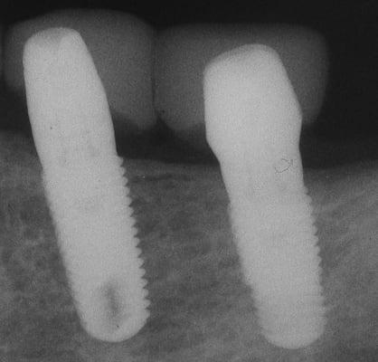 X-Ray of lower jaw implants with temporary crowns. Implants placed by Dr. Yuly Gertsberg