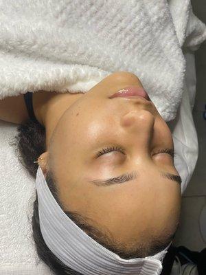 Results after hydrafacial