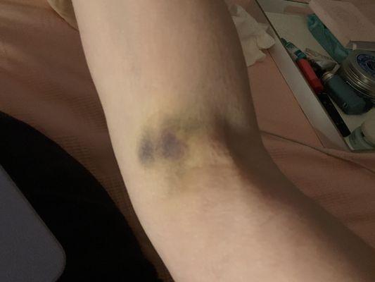 Hematoma day 4 post treatment