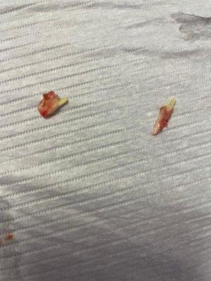 ingrown nail removed (the very first appointment)