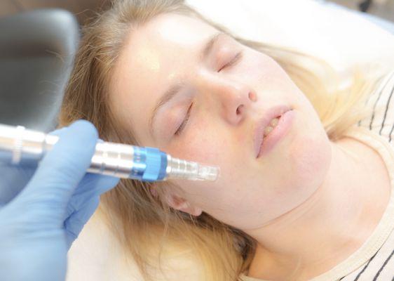 We offer PRP Microneedling for your facial cosmetic needs!