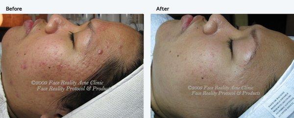 Inflamed Acne