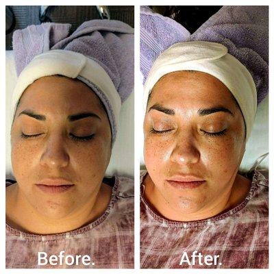 Dermaplane before and after!