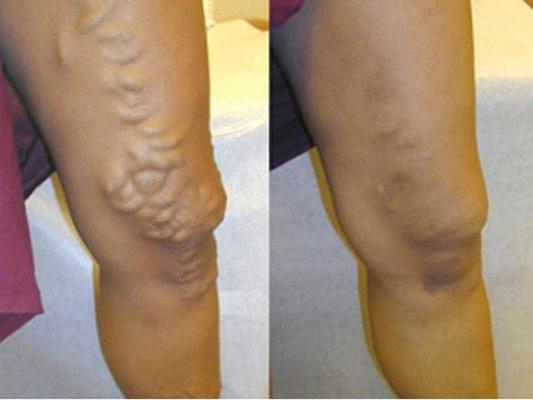 Varicose Vein Laser Center & Med Spa - tratamiento para venas varicosas